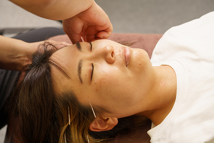 頭痛の鍼灸治療