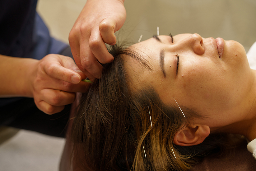 頭痛特化の鍼灸施術