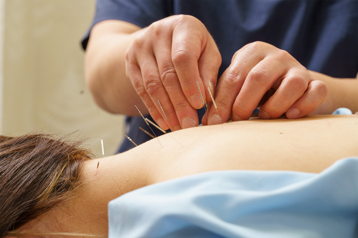 鍼灸治療とは